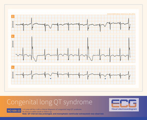 Patients with congenital long QT syndrome are at risk of developing complex ventricular premature contractions, paroxysmal ventricular tachycardia, torsades de Pointes, and ventricular fibrillation.