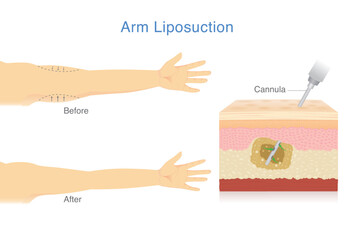 Reduce excess arm fat with Liposuction. Woman make sagging arm look firmer and more beautiful. Skin layer showing Cannula removes excess fat from the inner layers of the skin.