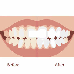 Teeth Whitening Before and After Illustration