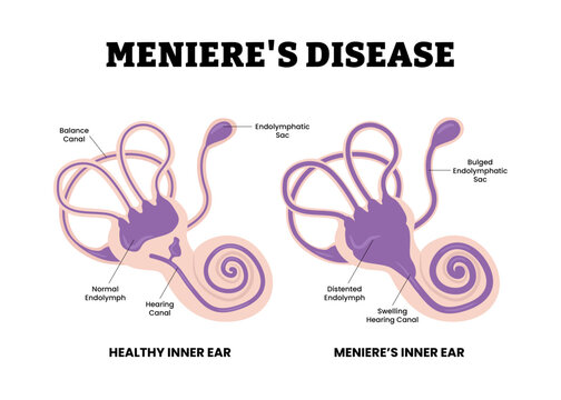 The Meniere's disease. Buildup of fluid in inner ear disorder in stuffy ear. Labeled canal, buldged endolymphatic sac, swelling hearing canal. Flat vector. Medical science educational illustration