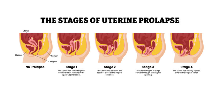 The stages of uterine prolapse stages development process. Labeled bladder, rectum, vagina, uterus. Pelvic floor muscles weakening, Support for the uterus loss.Medical science educational illustration