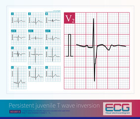 In some healthy children, adolescents, and adults, right chest V1 to V3 lead T wave inversion is a normal variant electrocardiogram.

