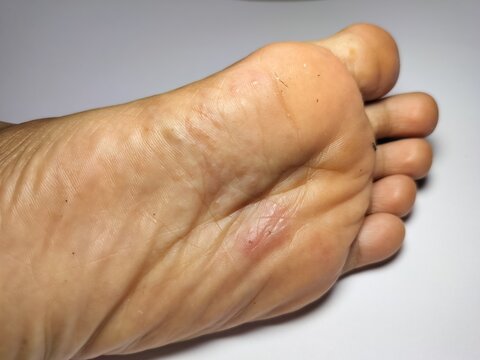 Visible scabies lesions on the feet of a child affected by post-flood conditions. Treatment typically involves topical scabicides such as permethrin cream,or  oral ivermectin in severe cases.