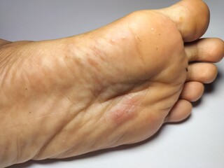 Fototapeta premium scabies, skin infection, child health, flood aftermath, Sarcoptes scabiei, dermatology, infectious disease, post-disaster illness, humanitarian crisis, tropical disease, hygiene-related illness, Malay