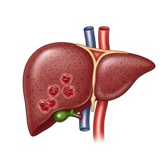 Liver Cancer Illustration - Understanding Hepatic Tumors and Anatomy.
