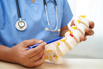 Asian doctor holding spinal nerve and bone model, Lumbar spine displaced herniated disc fragment for treatment medical in the orthopedic department.