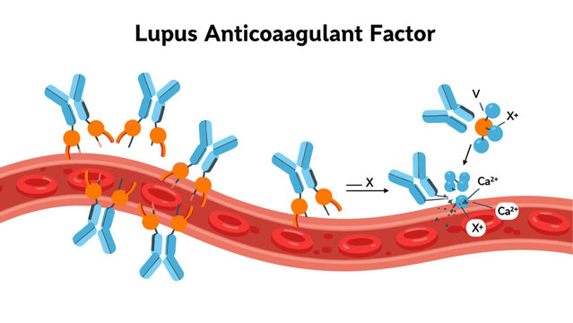 Lupus Anticoagulant Factor (LA) Mechanism in Blood Clotting Pathway