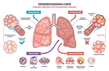 Understanding COPD, brief visual contrasts healthy lung with COPD lung, showing bronchi, mucus, and damaged alveoli to explain airflow obstruction and symptoms, transparent background.
