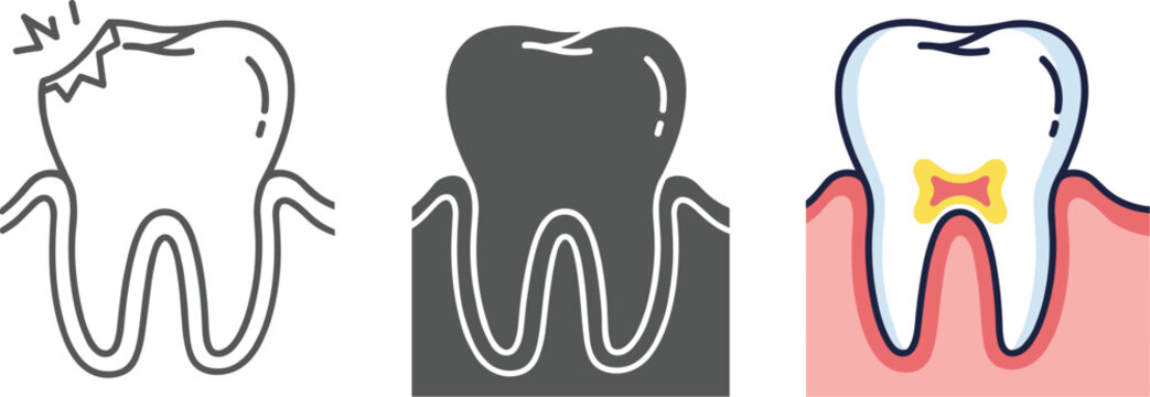 Tooth decay stages isolated on white background healthy tooth, initial caries, and advanced decay, dental health, oral hygiene, and prevention concept
