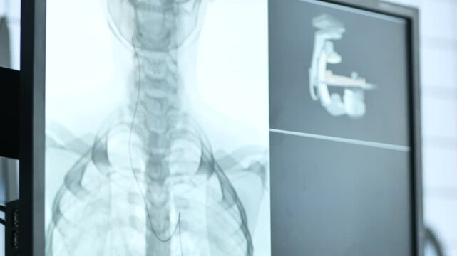 Medical imaging display showing human chest x-ray with an inserted catheter wire