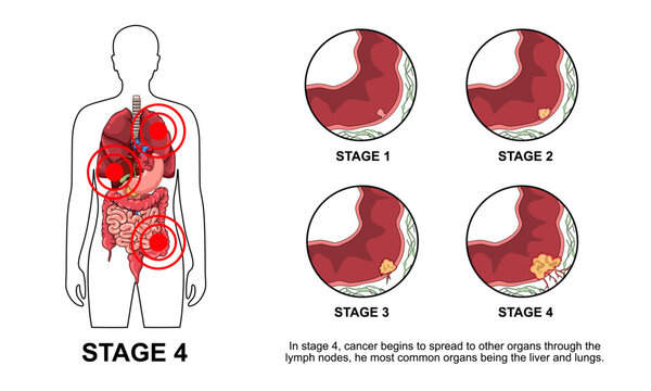 Illustration of colorectal cancer stages. Concept of colon cancer progression. Spread of tumor to lymph nodes. Medical vector illustration for clinics, education, and science.
