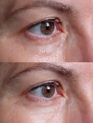 Fototapeta premium before after tired under eye puffiness vs refreshed smooth finish