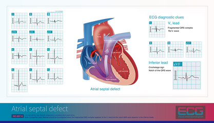 When the fragmented QRS complex appears in the V1 lead of ECG with the notch of QRS wave in the inferior lead, that is, the hook sign, it is necessary to screen for congenital heart disease.
