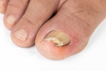 Ingrown toenail on a senior feet with white background
Close-up ingrown toenail on senior feet with white background.