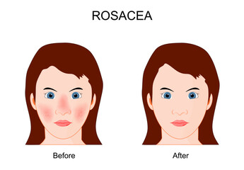 Rosacea. Face skin Before and After therapy.