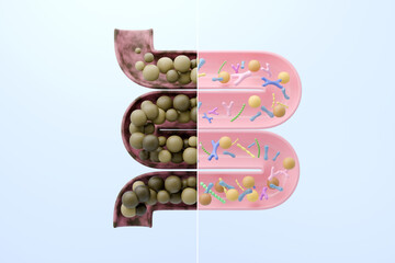 Comparison of unhealthy constipation versus healthy intestine with probiotics for detox concept. 3D illustration