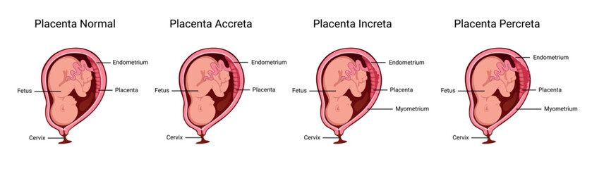 Obraz premium Placenta. Part of placenta attaches abnormally to the myometrium. Three grades of attachment according to the depth: Accrete, increta, percreta. Medical vector illustration