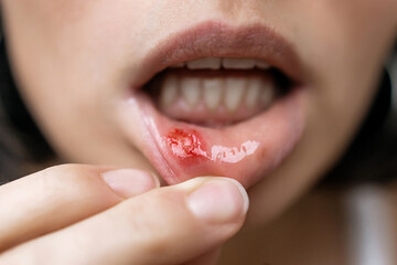 Close-up of a Woman Showing a Painful Canker Sore or Mouth Ulcer on Inner Lower Lip with Red Inflammation, Oral Mucosa Irritation and Dental Health Problem Concept © MarijaBazarova