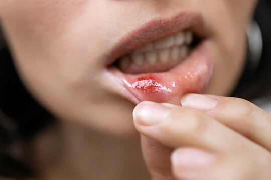 Close-up of a Woman Showing a Painful Canker Sore or Mouth Ulcer on Inner Lower Lip with Red Inflammation, Oral Mucosa Irritation and Dental Health Problem Concept