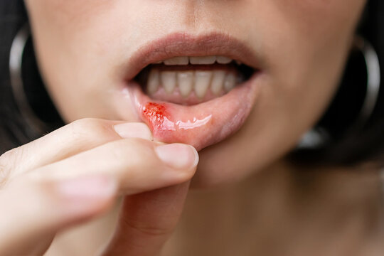 Close-up of a Woman Showing a Painful Canker Sore or Mouth Ulcer on Inner Lower Lip with Red Inflammation, Oral Mucosa Irritation and Dental Health Problem Concept