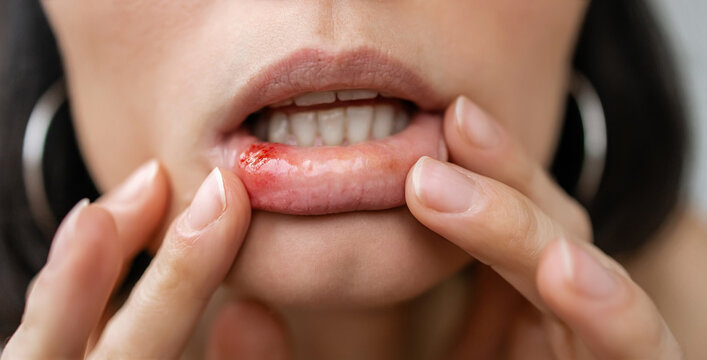 Close-up of a Woman Showing a Painful Canker Sore or Mouth Ulcer on Inner Lower Lip with Red Inflammation, Oral Mucosa Irritation and Dental Health Problem Concept