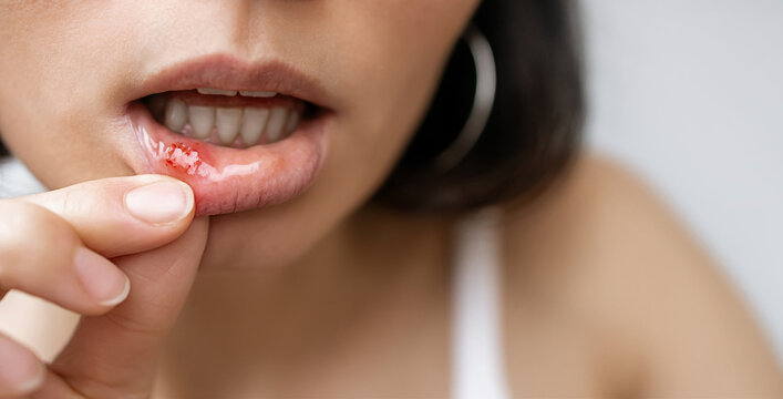 Close-up of a Woman Showing a Painful Canker Sore or Mouth Ulcer on Inner Lower Lip with Red Inflammation, Oral Mucosa Irritation and Dental Health Problem Concept