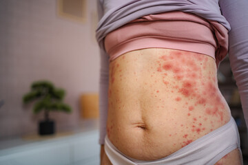 Woman showing red rash on stomach skin illness
