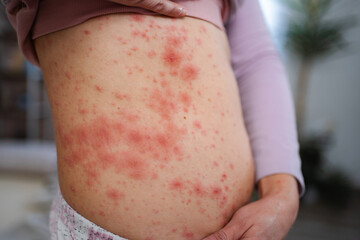 Adult person experiencing severe skin rash and irritation