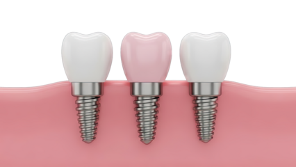 Dental implants with a pink tooth and white teeth shown in a healthy pink gum with a transparent background illustration for dental care and technology concepts