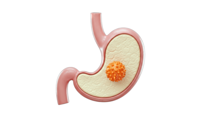 Stomach Cancer Illustration: Medical Concept on White Background