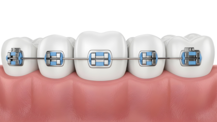 Front view of human teeth with metal braces and blue elastic ties on white background