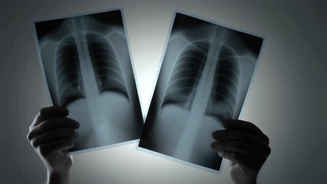 A radiologist carefully analyzes two chest x-ray films, holding them up to a light source to compare lungs and diagnose a condition
