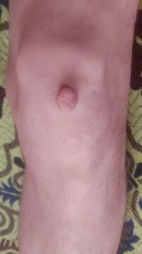 Big wart on the knee