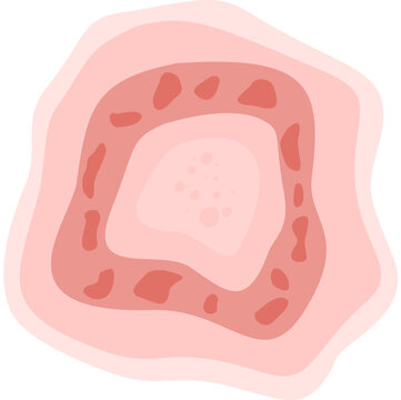 Dermatophytosis illustration