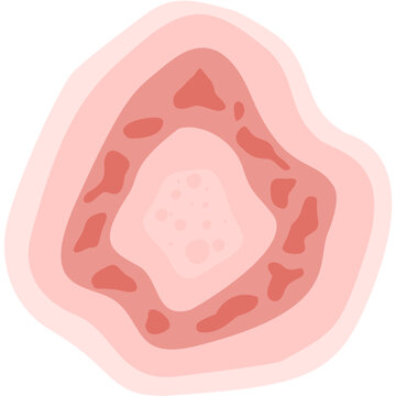 Dermatophytosis illustration