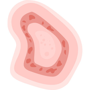 Dermatophytosis illustration