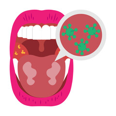 Mouth Infection Illustrator