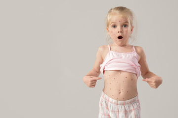 Shocked little girl ill with chickenpox on light background