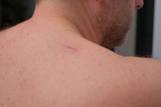 Male upper back and shoulder close-up showing a purple post-surgical scar from dermatological cyst removal, highlighting healing skin, sutures and post-operative recovery details