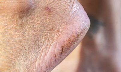 Close-up of cracked and dry heels showing damaged skin texture, perfect for foot care, podiatry and skincare related content