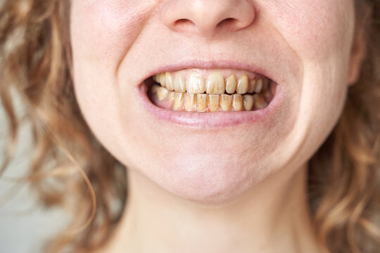 Female Caucasian adult teeth with plaque and tartar close up dental hygiene problem.