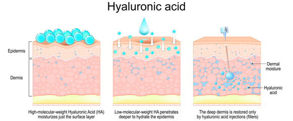 Hyaluronic acid and Dermal moisture. Skin benefits after filler&nbsp;injections.