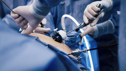 Surgical team performing minimally invasive procedure using advanced tools, showcasing precision and teamwork in a sterile operating room environment with blue drapes and medical equipment