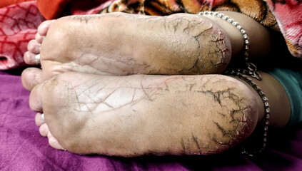 Close-Up of Cracked Heels and Bare Feet