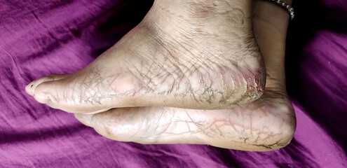 Close-Up of Cracked Heels and Bare Feet