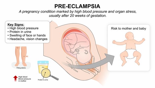 Pre-eclampsia Pregnancy Complication Medical Infographic Flashcard