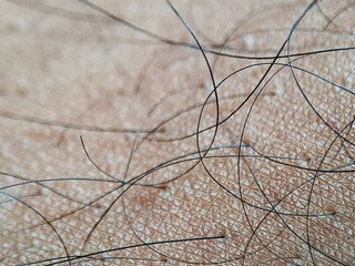 Extreme macro close up of human skin showing follicles, numerous dark hairs, and several small, dark, raised moles or skin tags, highlighting dermatology and microscopic biological texture in daylight