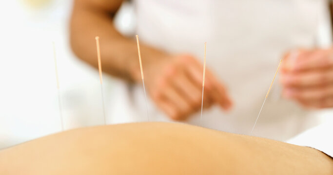 Back, person and needle for acupuncture at spa for muscle tension, natural pain relief and healing. Closeup, people and traditional medicine for physical therapy, joint inflammation and dry needling