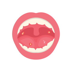 Mouth Infection Illustration