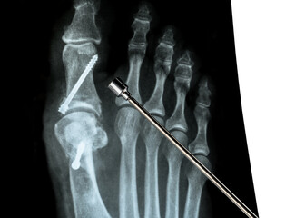 Metal pointer in front of X-ray of the front foot after Hallux Valgus surgery white background